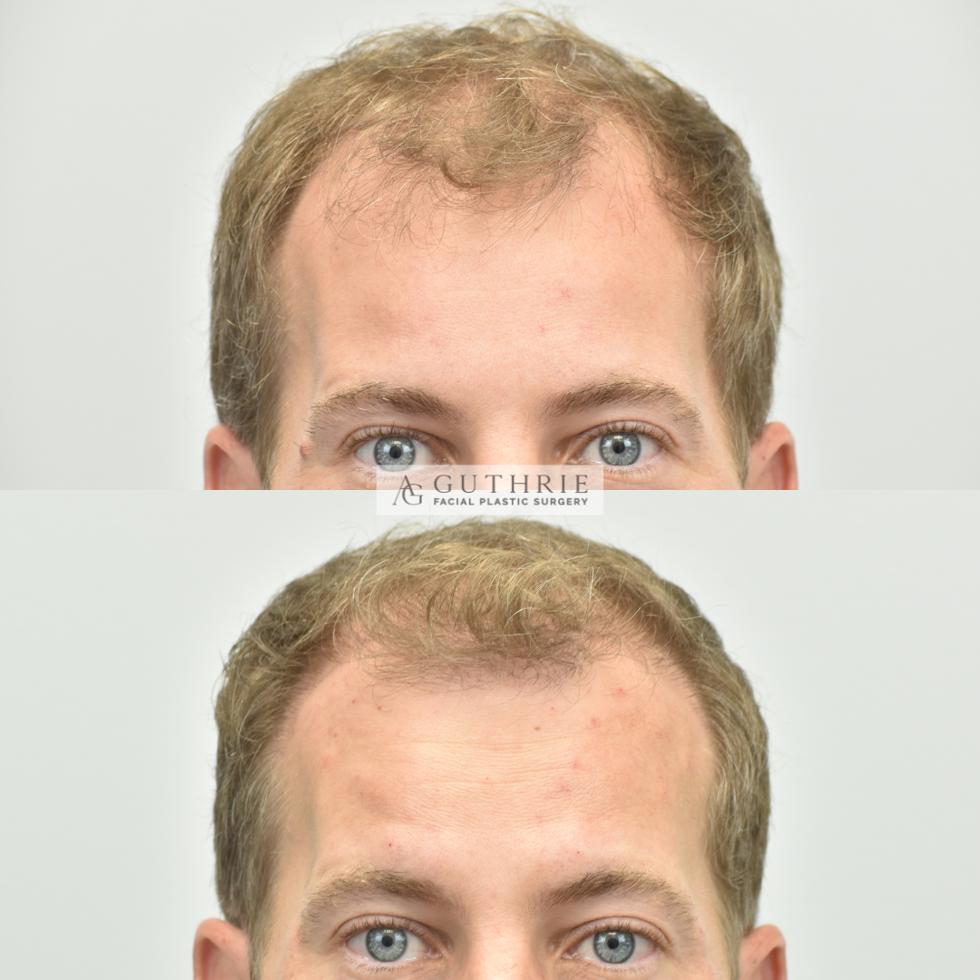 DB+Hair+Transplant+Before+and+After+in+Nashville+Guthrie+Facial+Plastic+Surgery+Brentwood