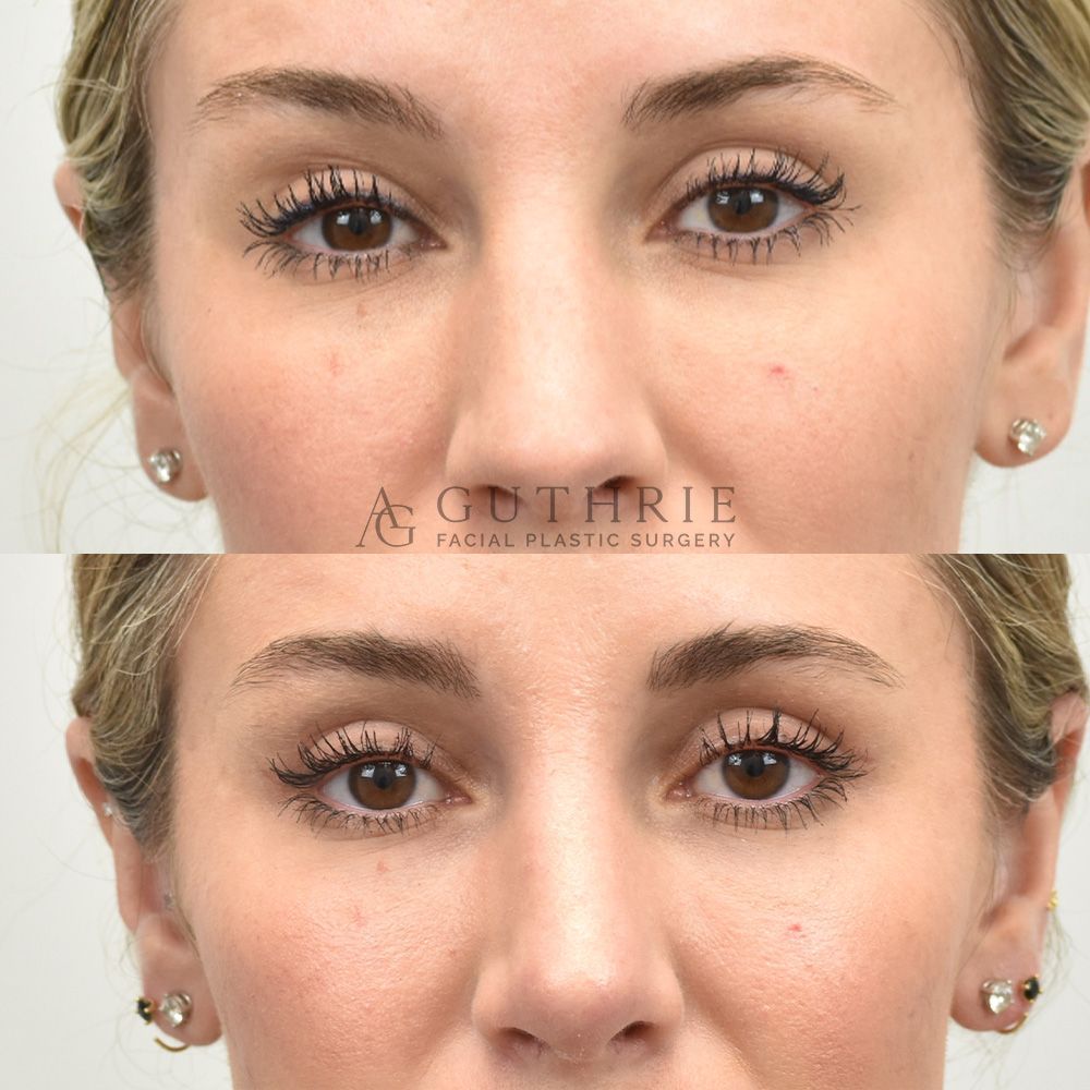 30s blonde woman before and after upper blepharoplasty procedure performed by Dr. Ashley Guthrie