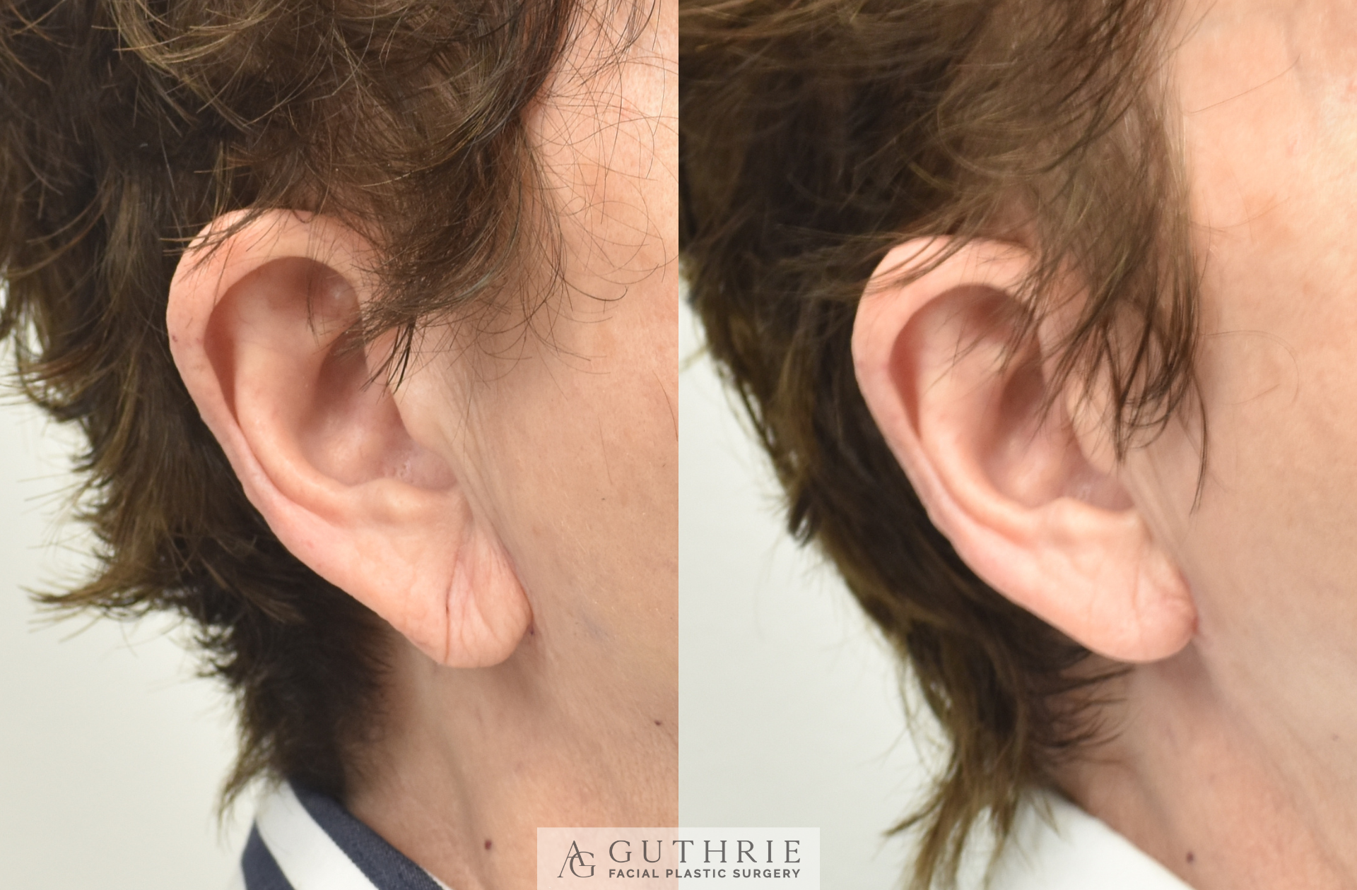 patient before and after earlobe reduction surgical procedure in brentwood tn guthrie facial plastic surgery