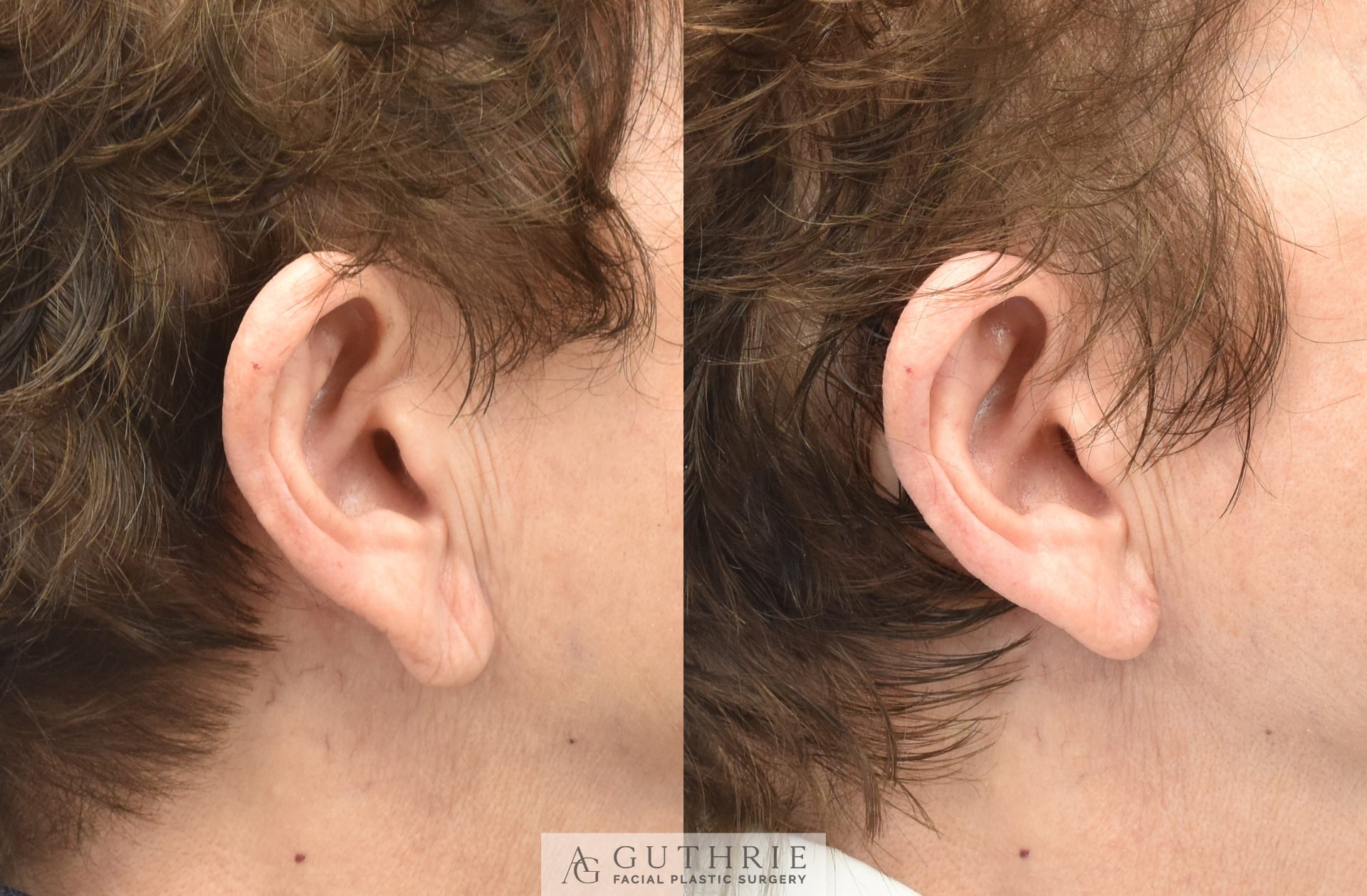 Before and After Earlobe Reduction