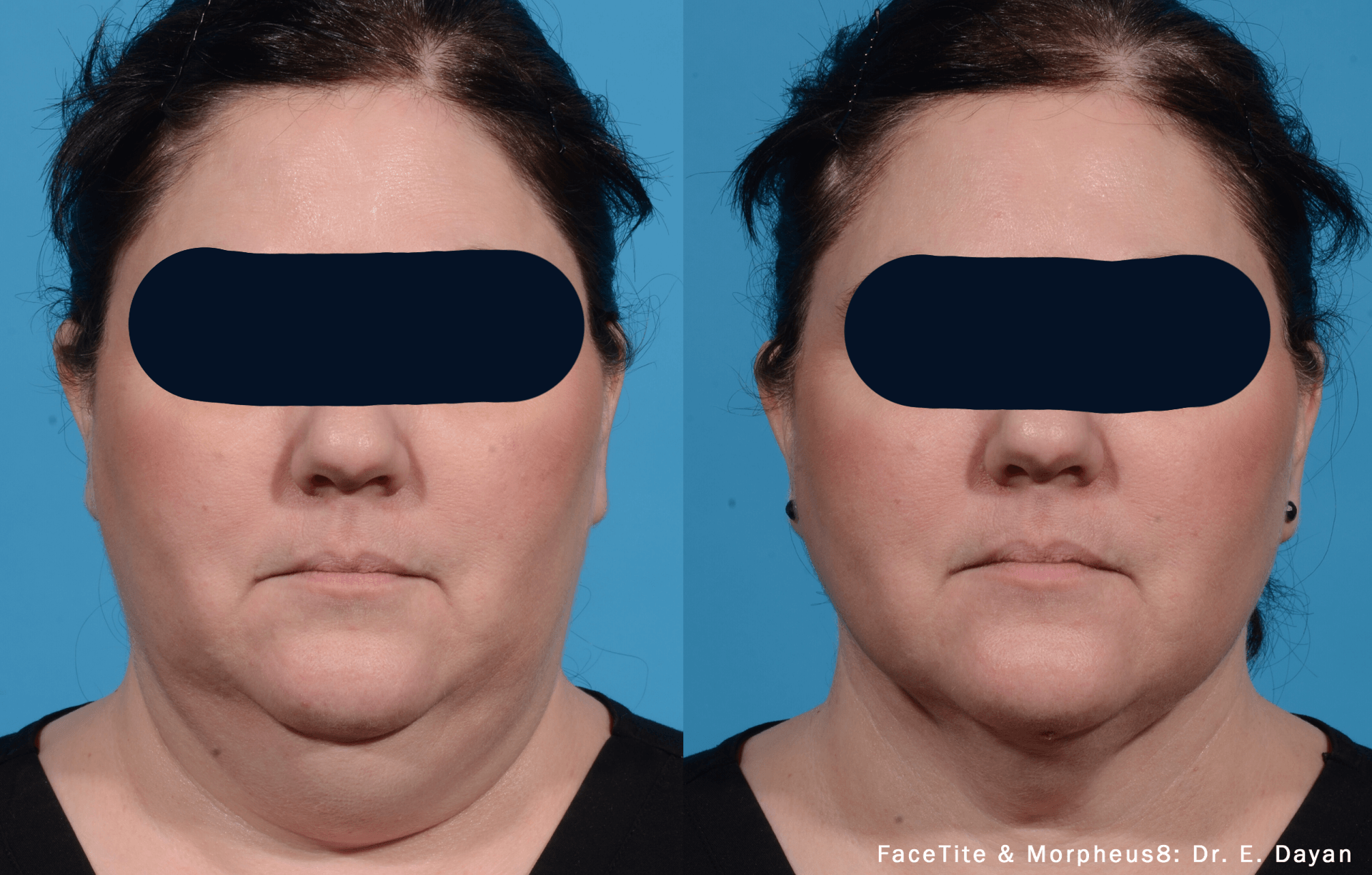 woman's under-chin before and after FaceTite treatment