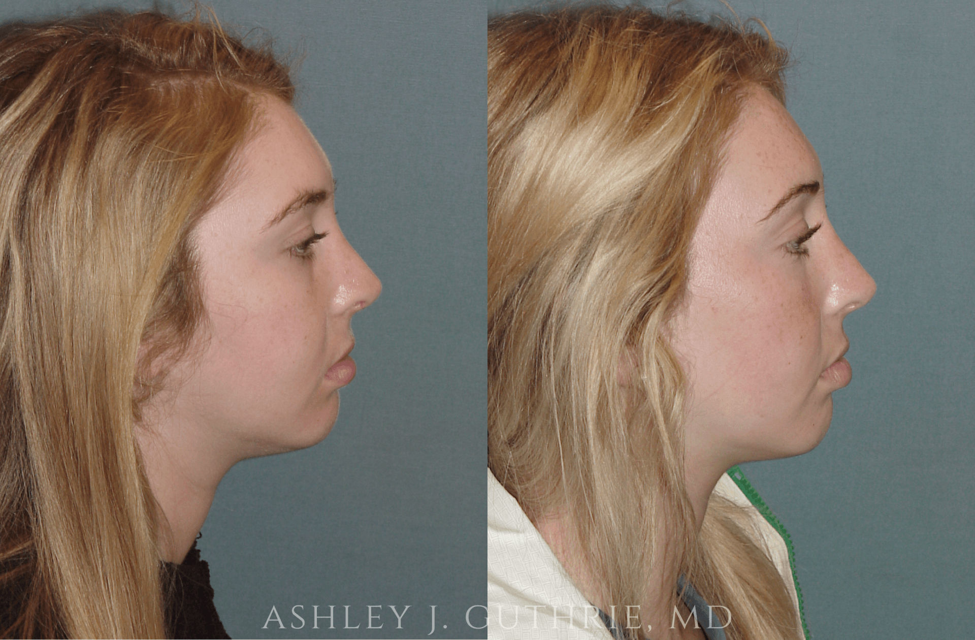 female patient before and after Chin Implant procedure by Dr. Guthrie