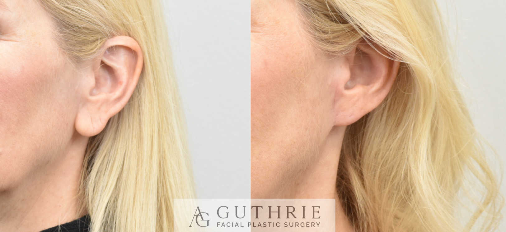 Before and After Bilateral Earlobe Reduction