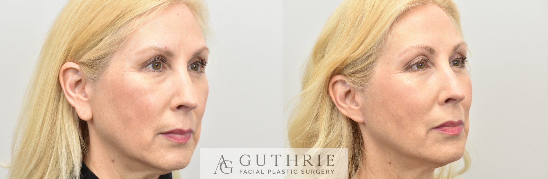 woman before and after earlobe reduction