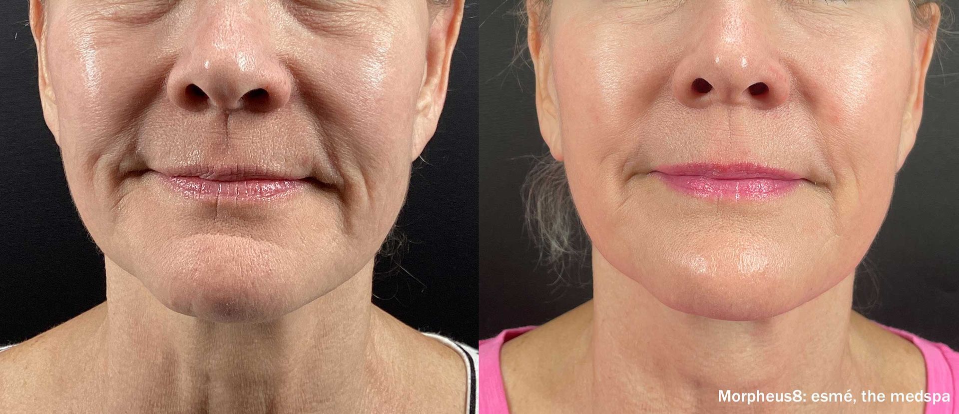 a woman's face before and after Morpheus8 treatment