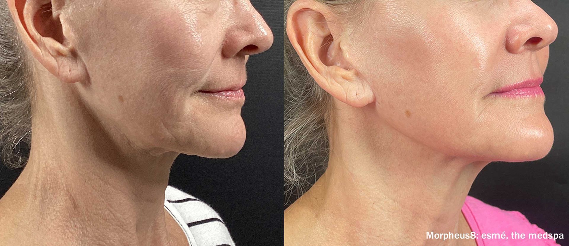 a woman's face before and after Morpheus8 treatment