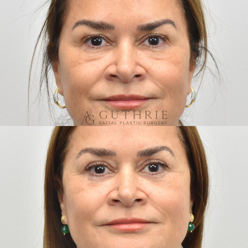 a woman's face shown before and after upper and lower blepharoplasty procedures performed by Dr. Ashley Guthrie