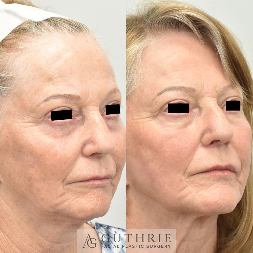 woman's face before and after CO2 laser treatment