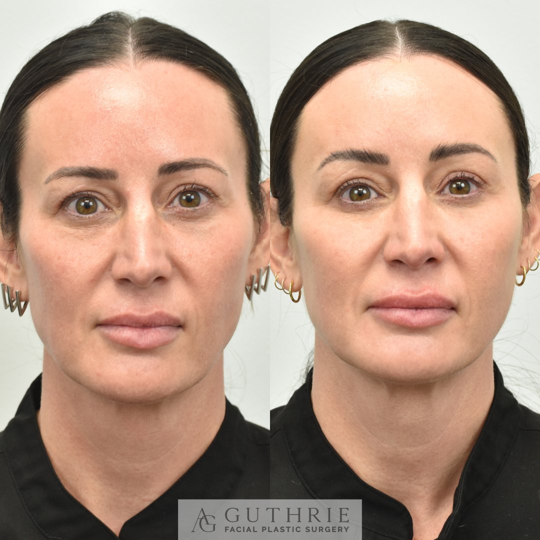 before and after lower blepharoplasty guthrie facial plastic surgery brentwood tn