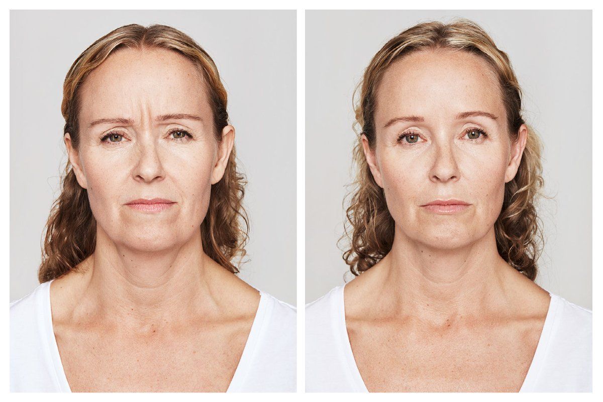 patient before and after treatment with Dysport® injectable for wrinkles