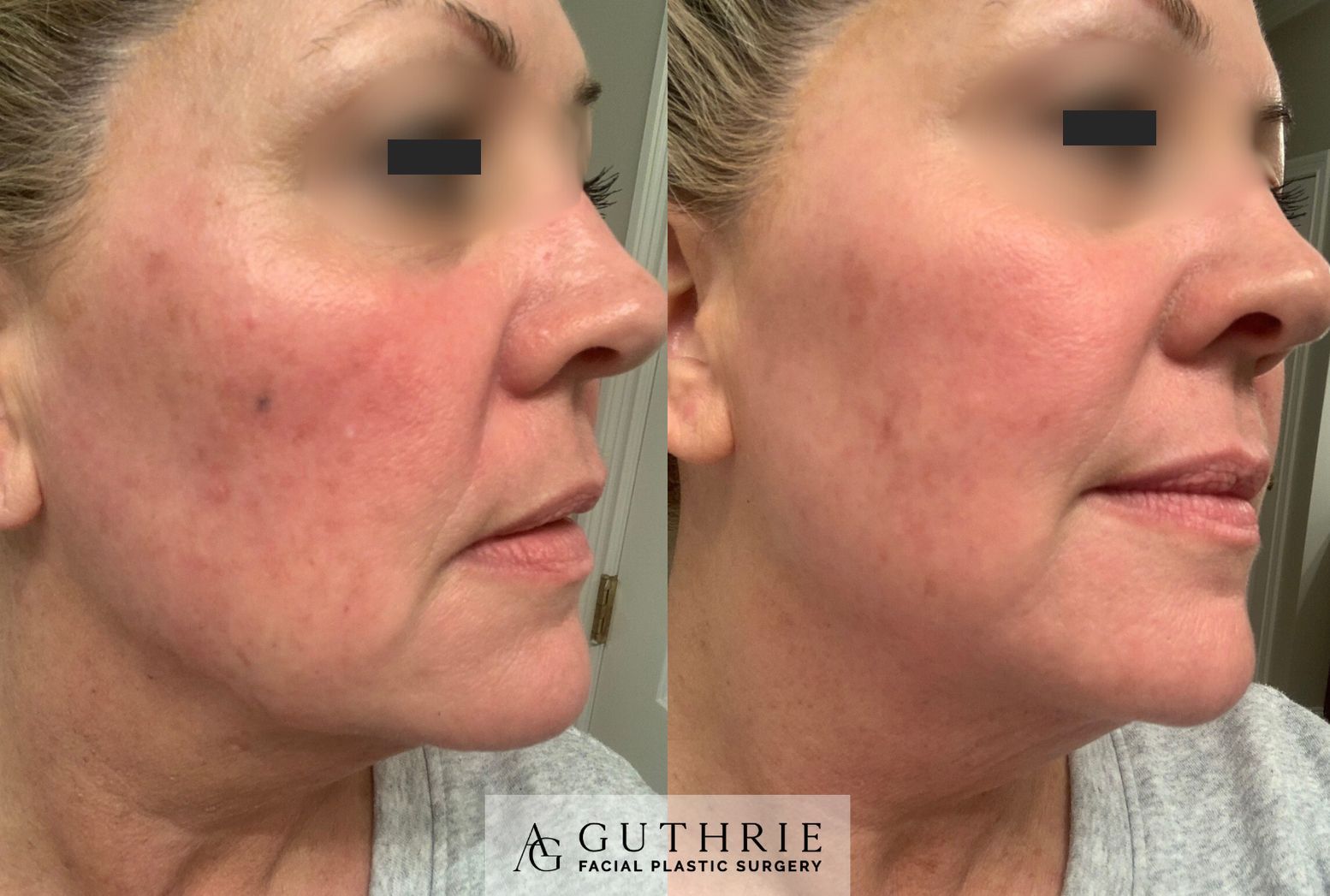 closeup of patient's face before and after treatment with Tetra C02 laser
