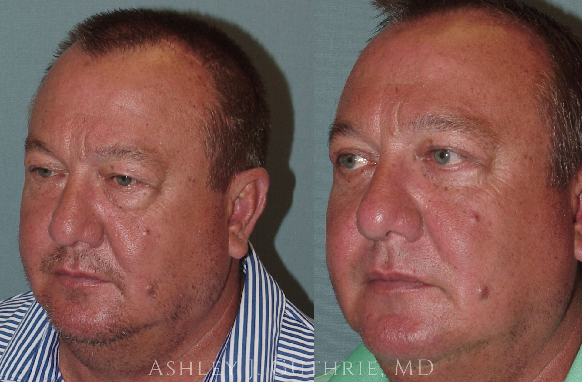 a man before and after blepharoplasty