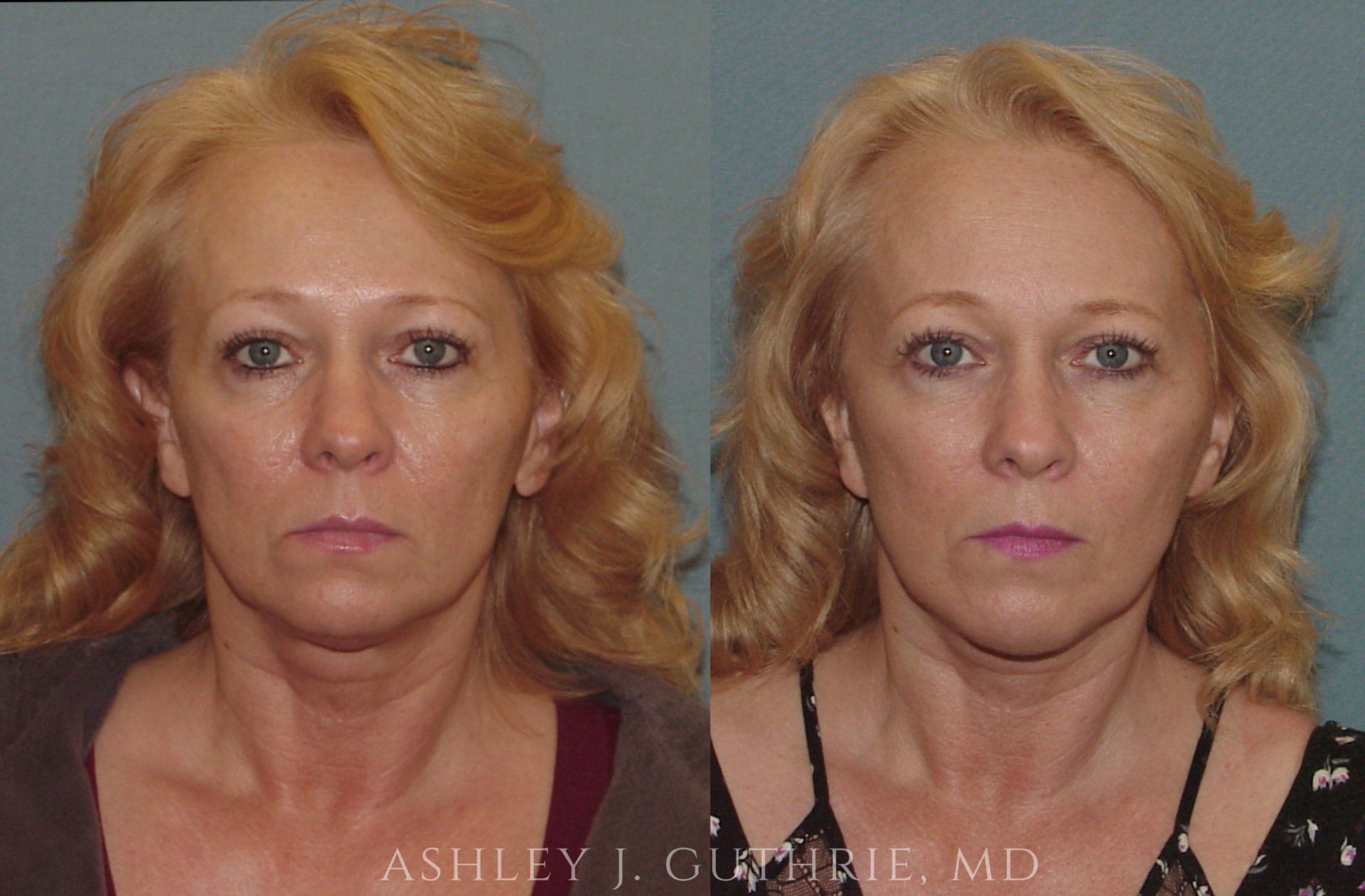 Guthrie Plastic Surgery patient before and after facelift