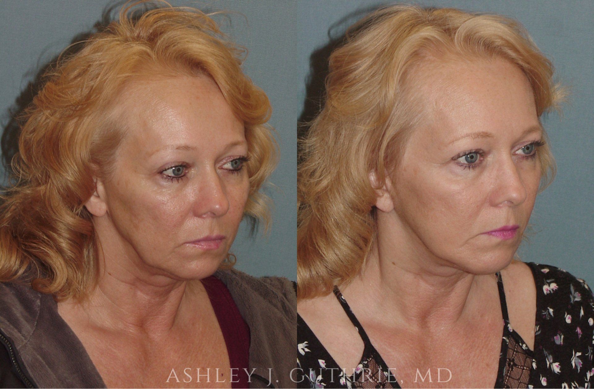 before & after - facial implants