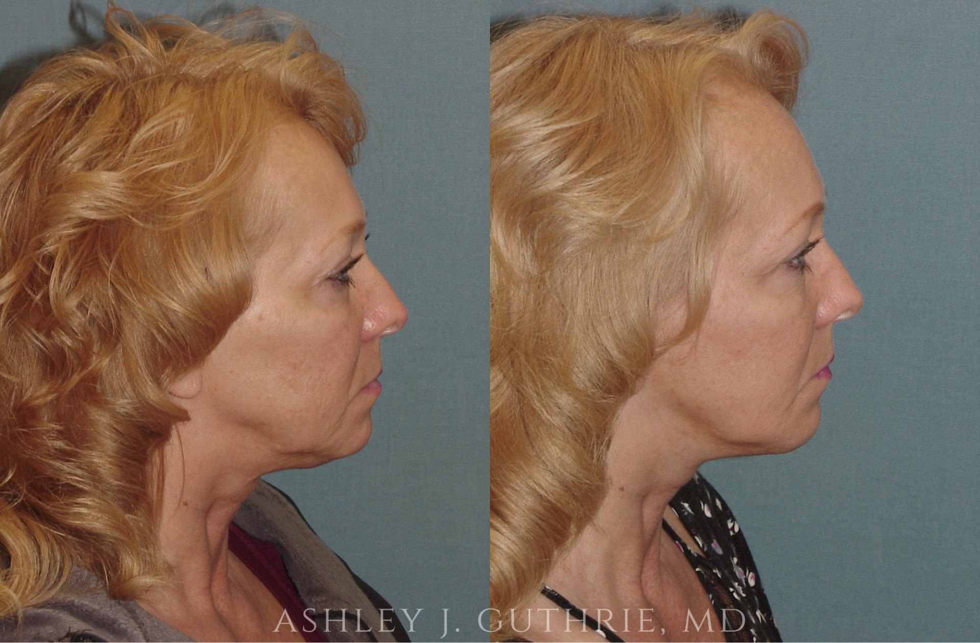 female patient before and after facial cosmetic surgery by Dr. Guthrie