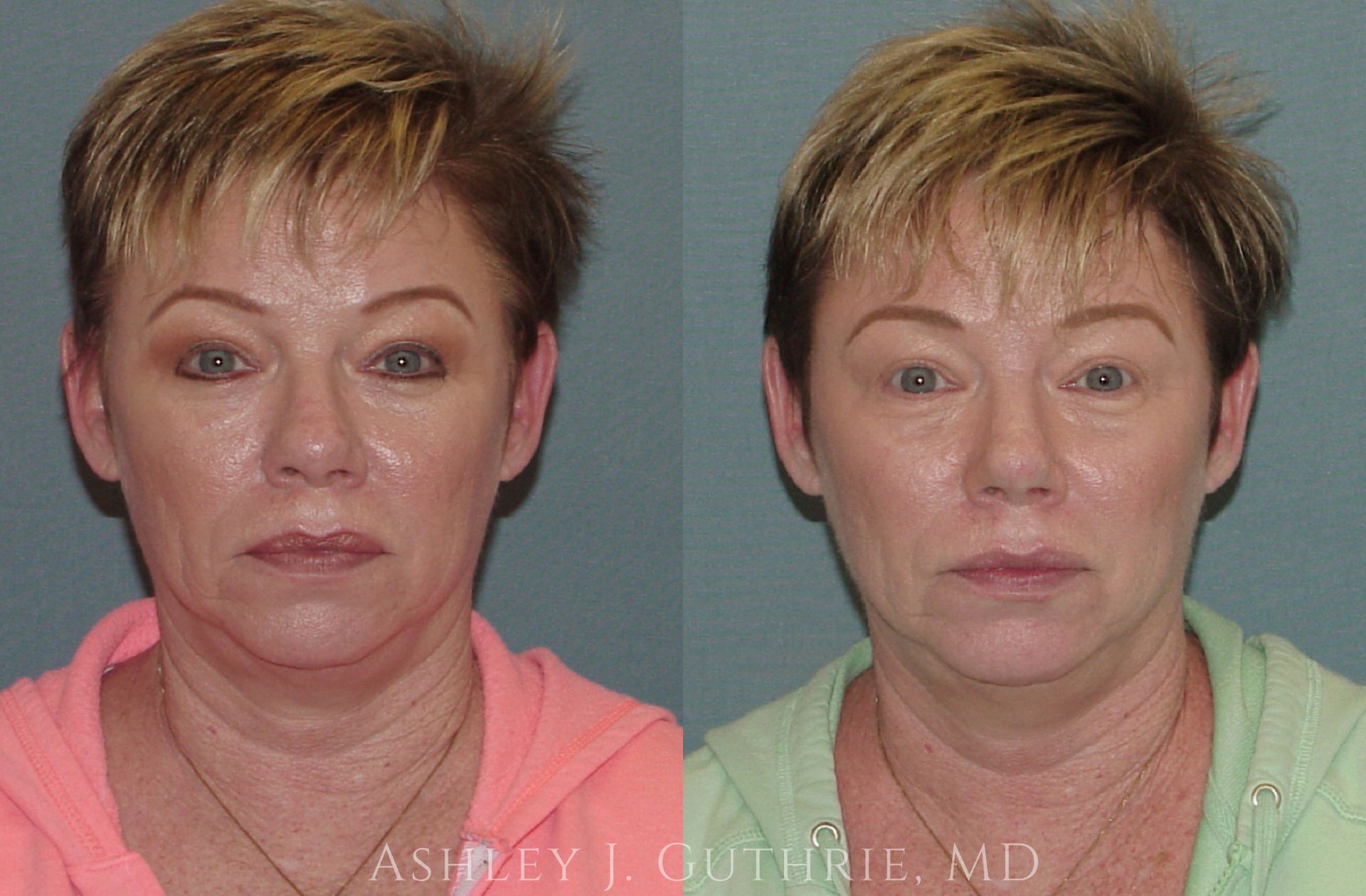 woman before and after rhinoplasty procedure
