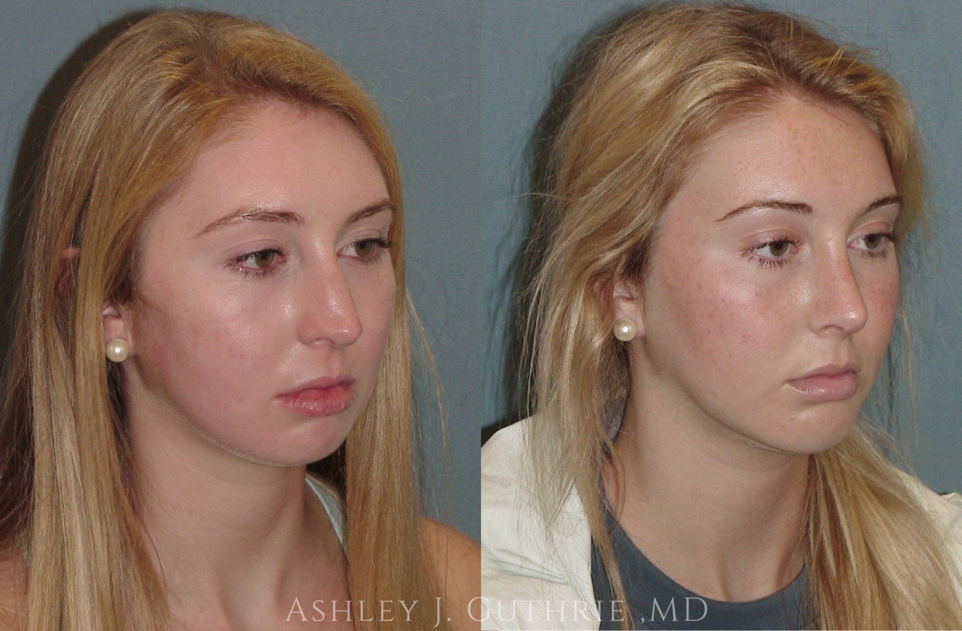 Guthrie Facial Plastic Surgery rhinoplasty patient before and after