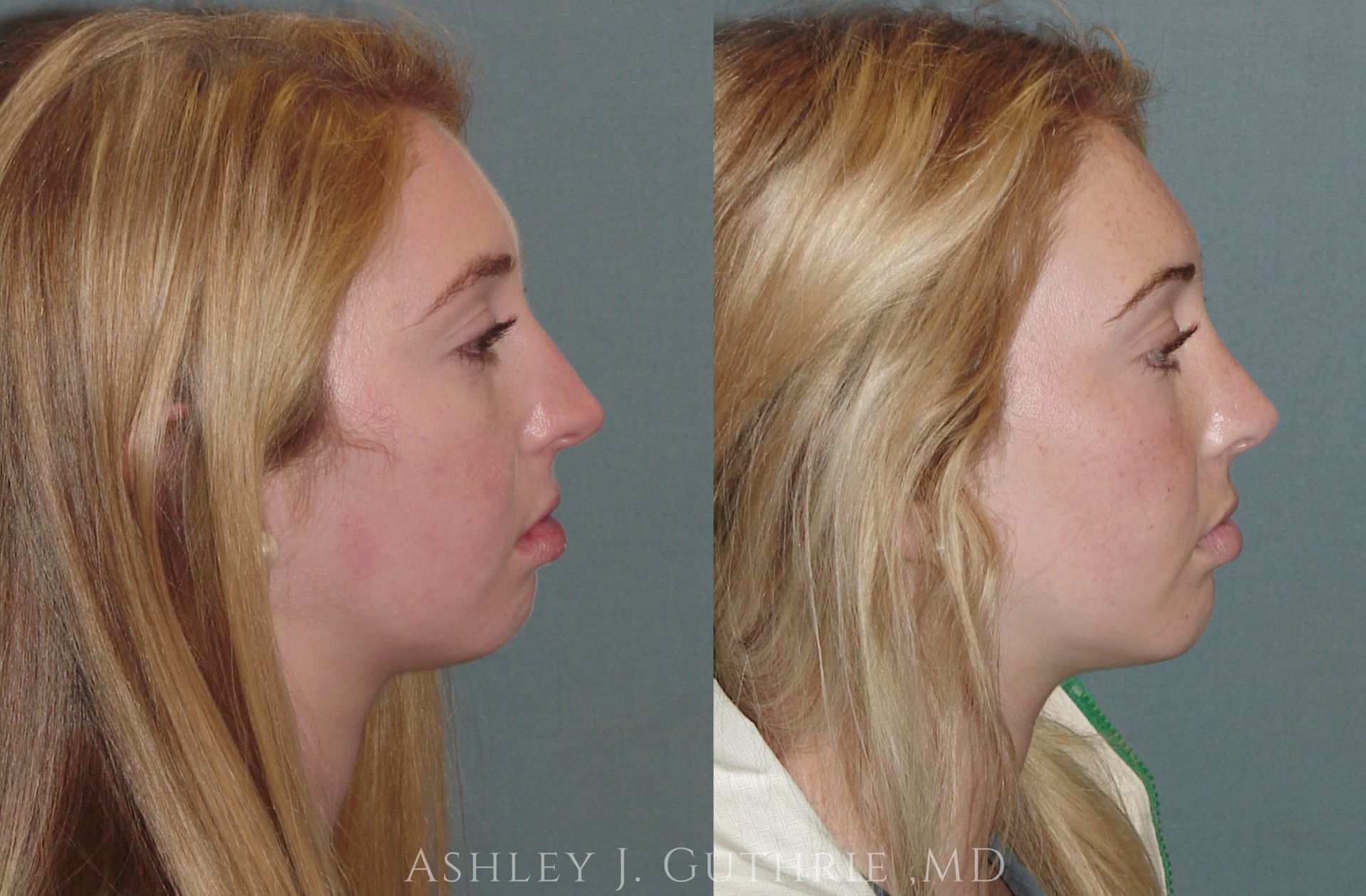 woman before and after chin implant procedure