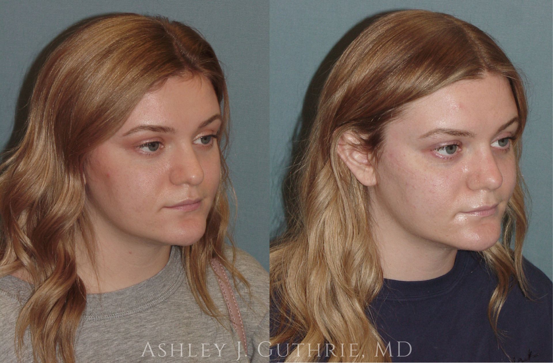 young woman before and after rhinoplasty procedure