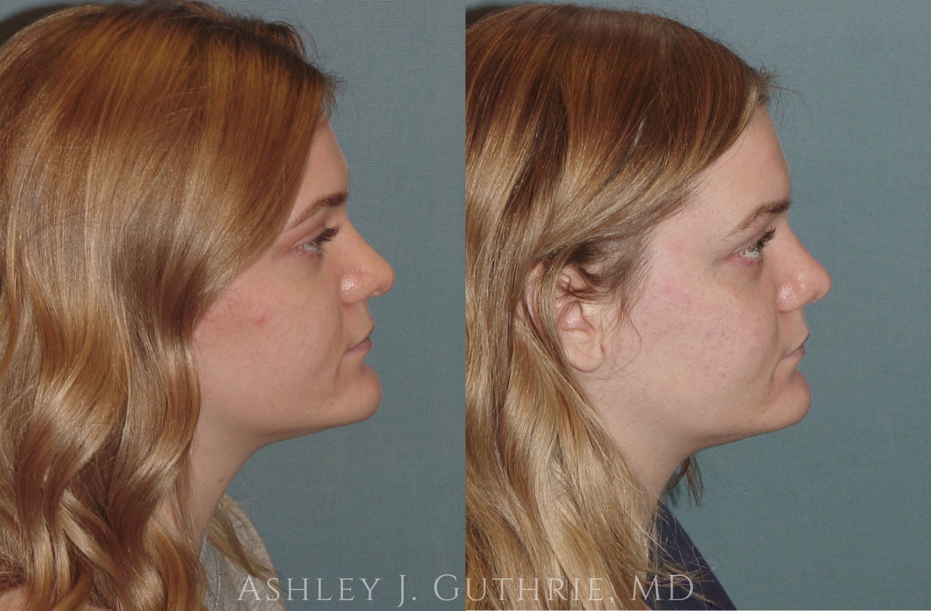 before & after - rhinoplasty