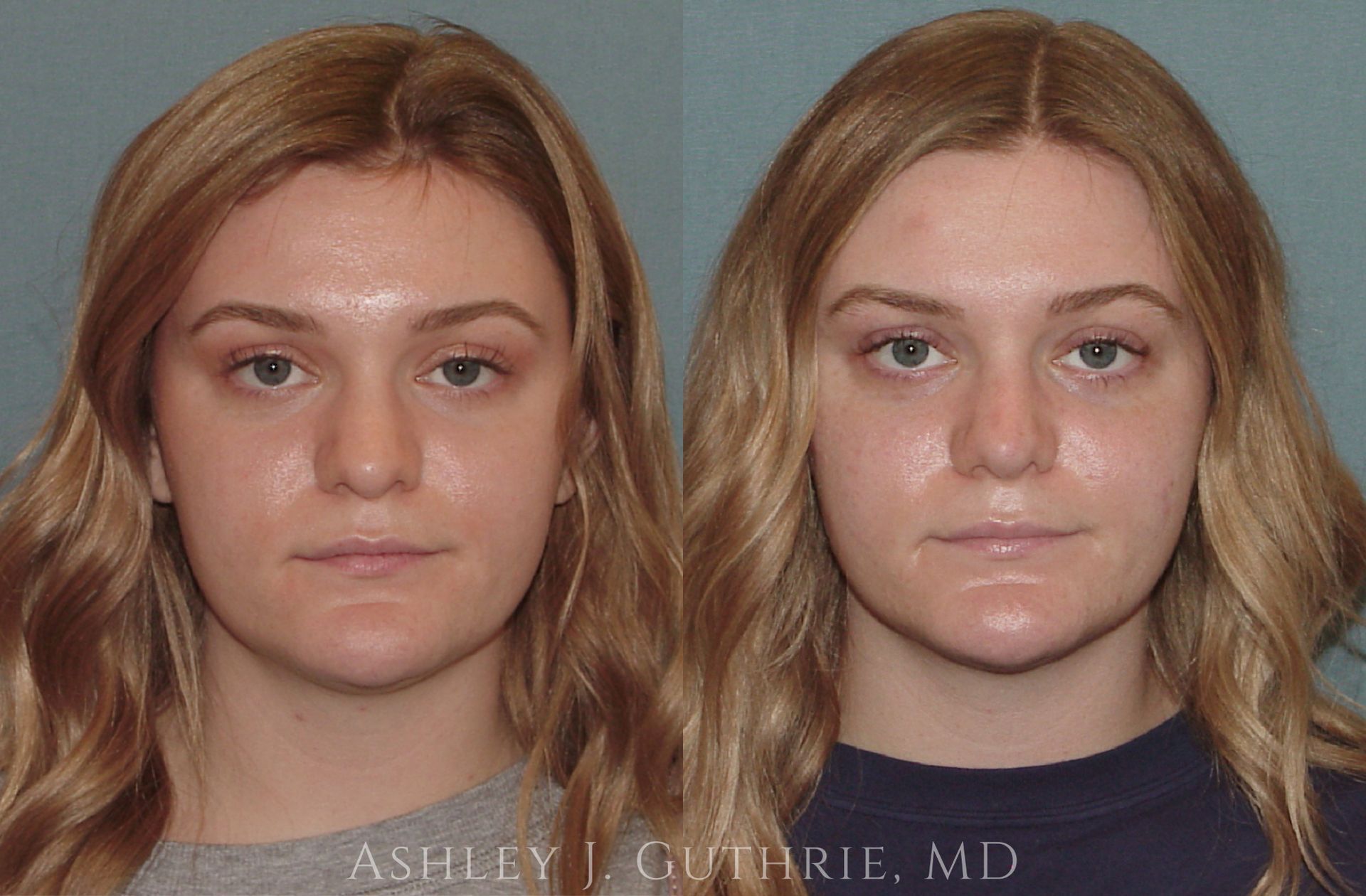 before & after - rhinoplasty