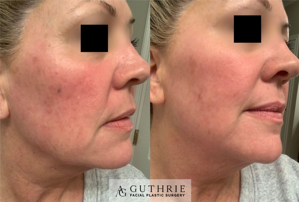 female patient before and after 1 tetra co2 laser treatment