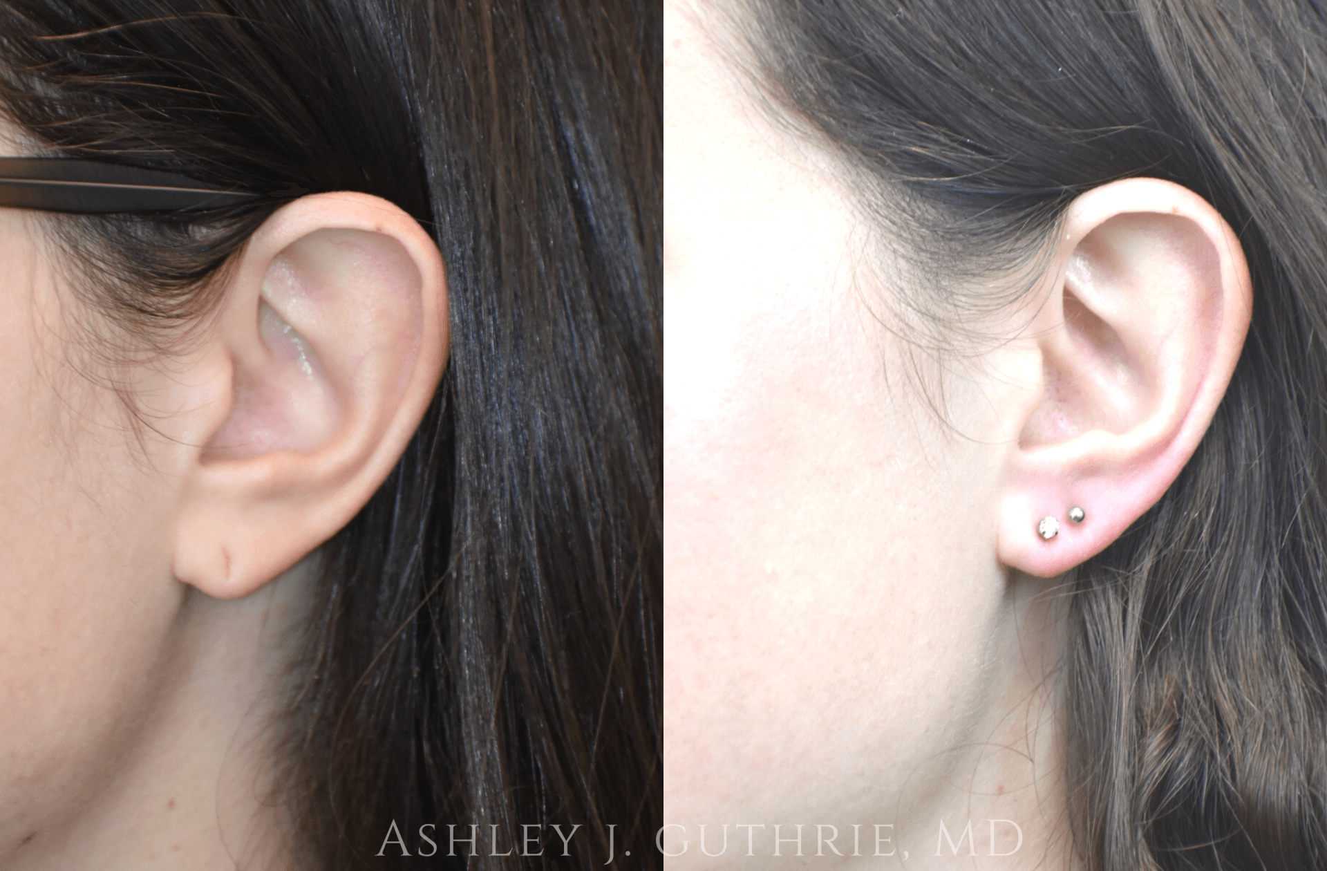 closeup of ears Before and After Earlobe Repair