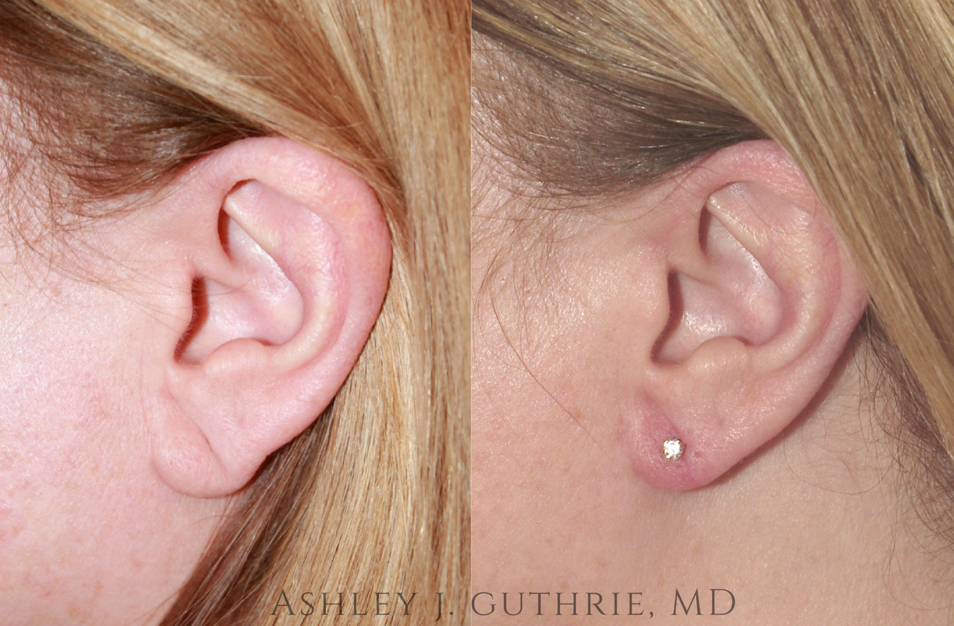 closeup of woman's ears before and after earlobe repair