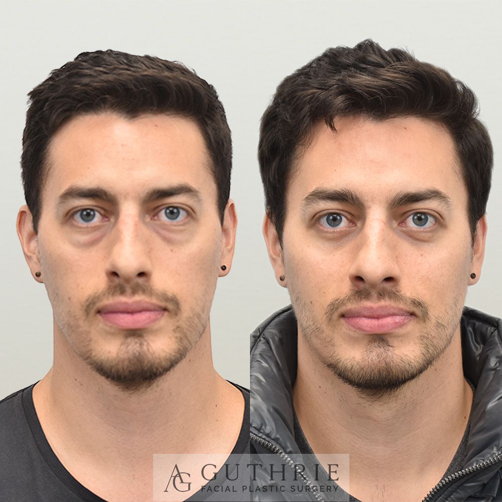 closeup of a young man's face shown before and after lower blepharoplasty