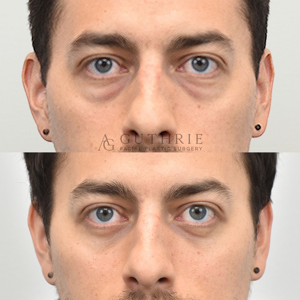 Before and After Lower Blepharoplasty with Fat Transfer