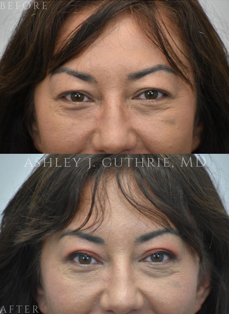 a woman before and after blepharoplasty