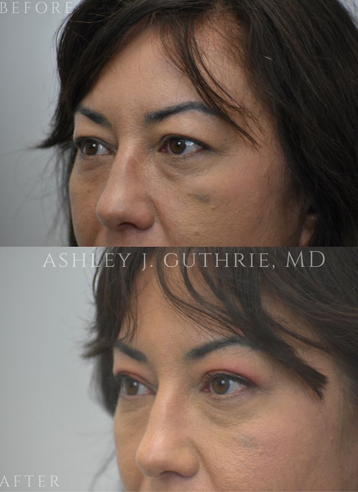 a woman before and after blepharoplasty