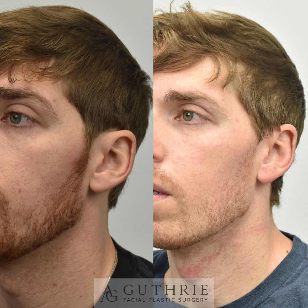 a before and after photo of a man 's face after otoplasty procedure