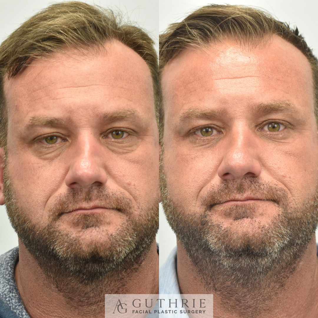 Lower Blepharoplasty, Fat Transfer, CO2 Laser Resurfacing in Brentwood tennessee at guthrie facial plastic surgery