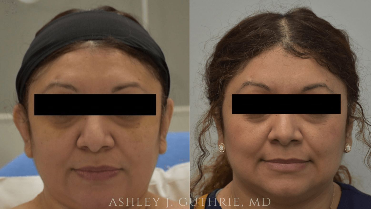 a woman before and after otoplasty ear surgery