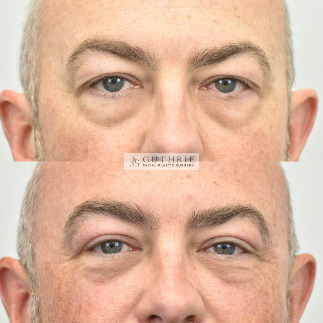 Before and After Upper and Lower Blepharoplasty - Guthrie Facial Plastic Surgery