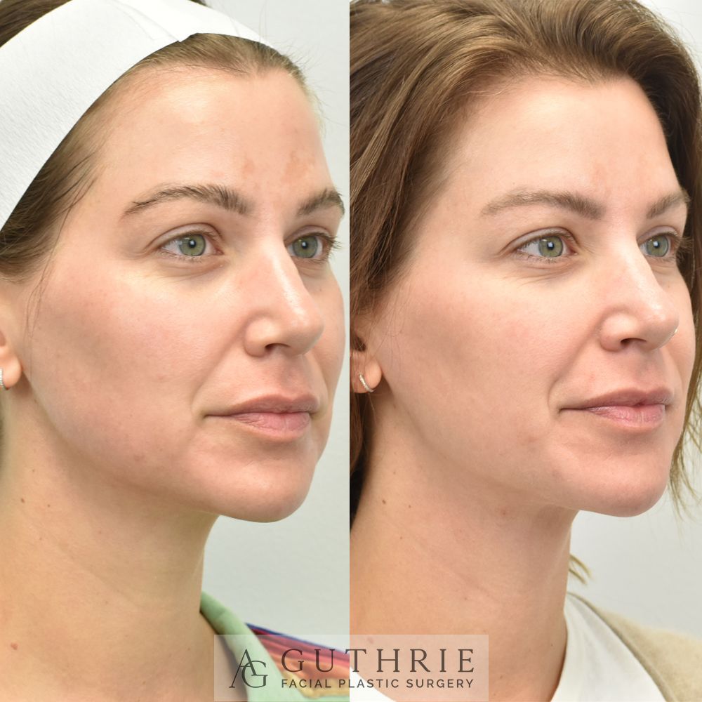 female patient's face before and after CoolPeel laser treatment