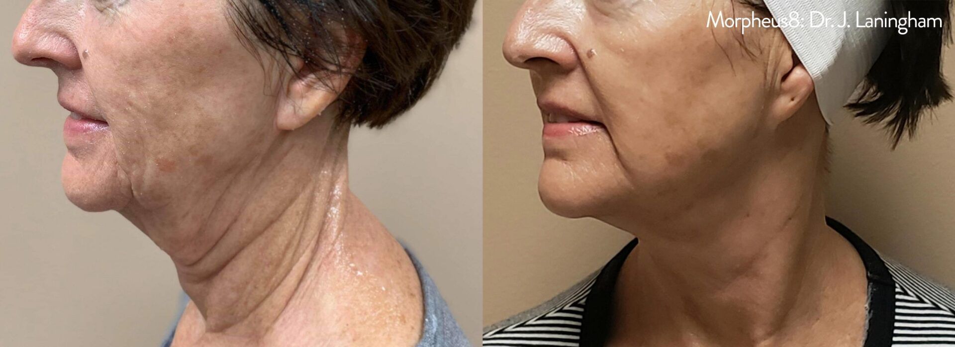 mature female patient before and after Morpheus8 face contouring treatment