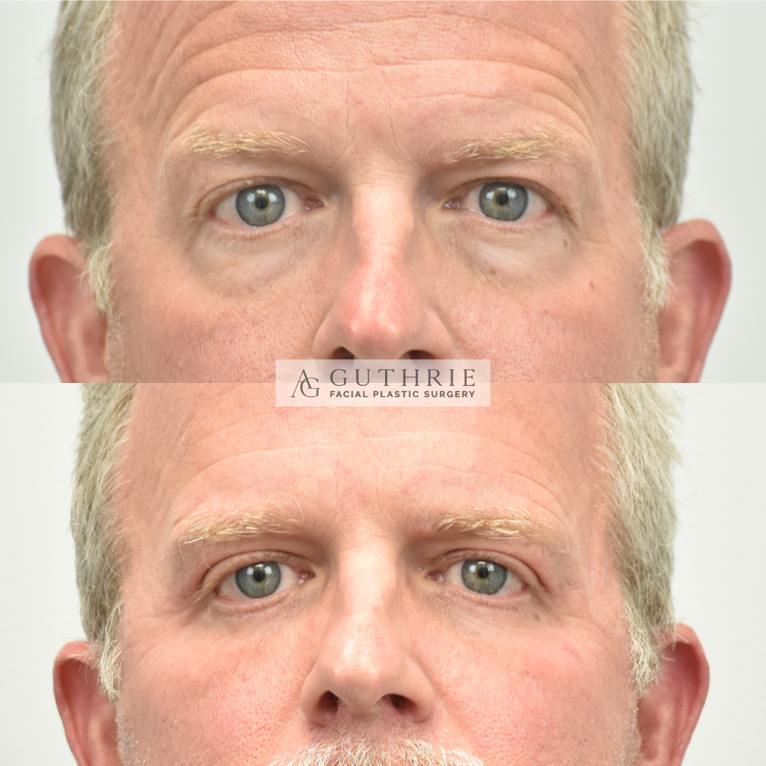 patient at guthrie facial plastic surgery before and after Upper and Lower Blepharoplasty, Endoscopic Brow Lift - brentwood tn