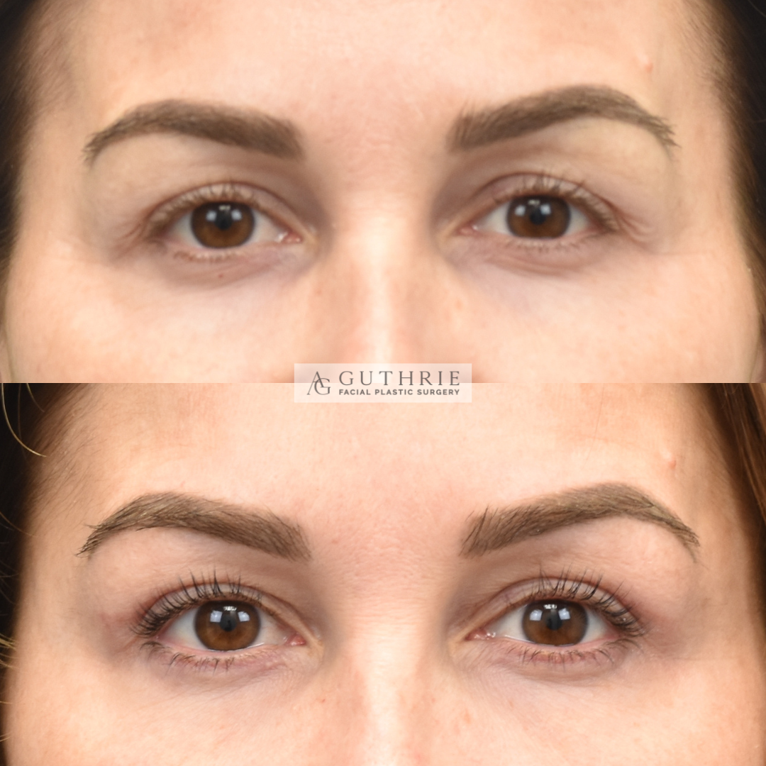 Before and After Upper Blepharoplasty, Lower Skin Pinch, Conservative Fat Grafting, Coolpeel Under Eyes