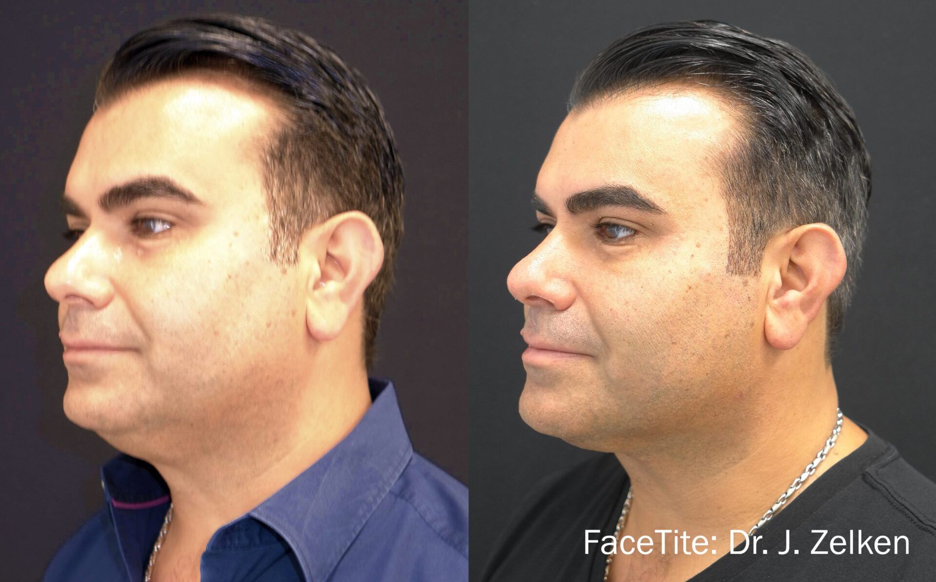 man's face before and after FaceTite cosmetic treatment