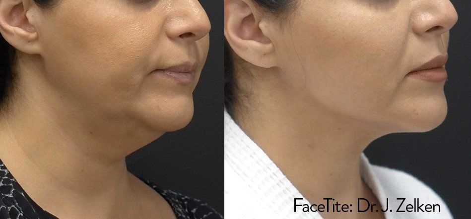 a woman's under-chin before and after FaceTite treatment
