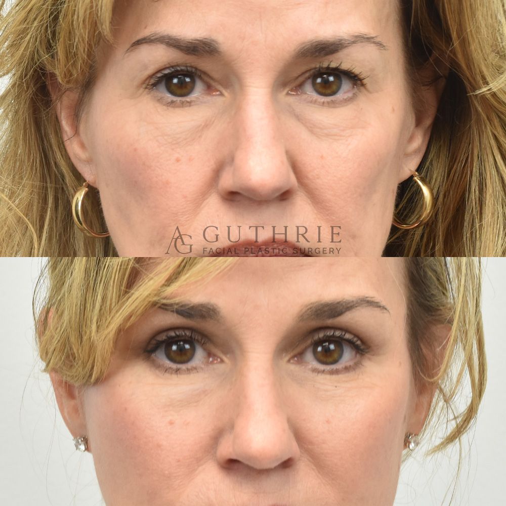 mature blonde woman's face shown before and after blepharoplasty procedure