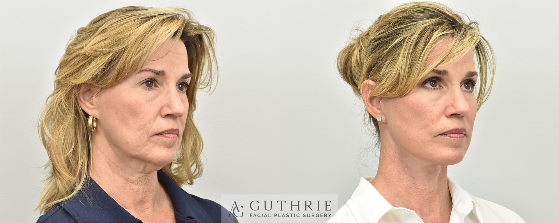 mature blonde woman's face shown before and after facelift procedure