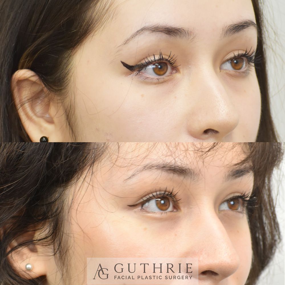 woman before and after lower blepharoplasty