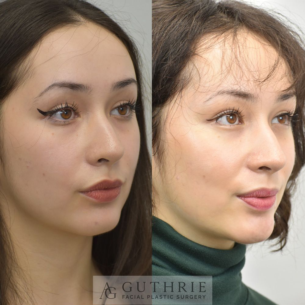 a woman before and after direct submental liposuction