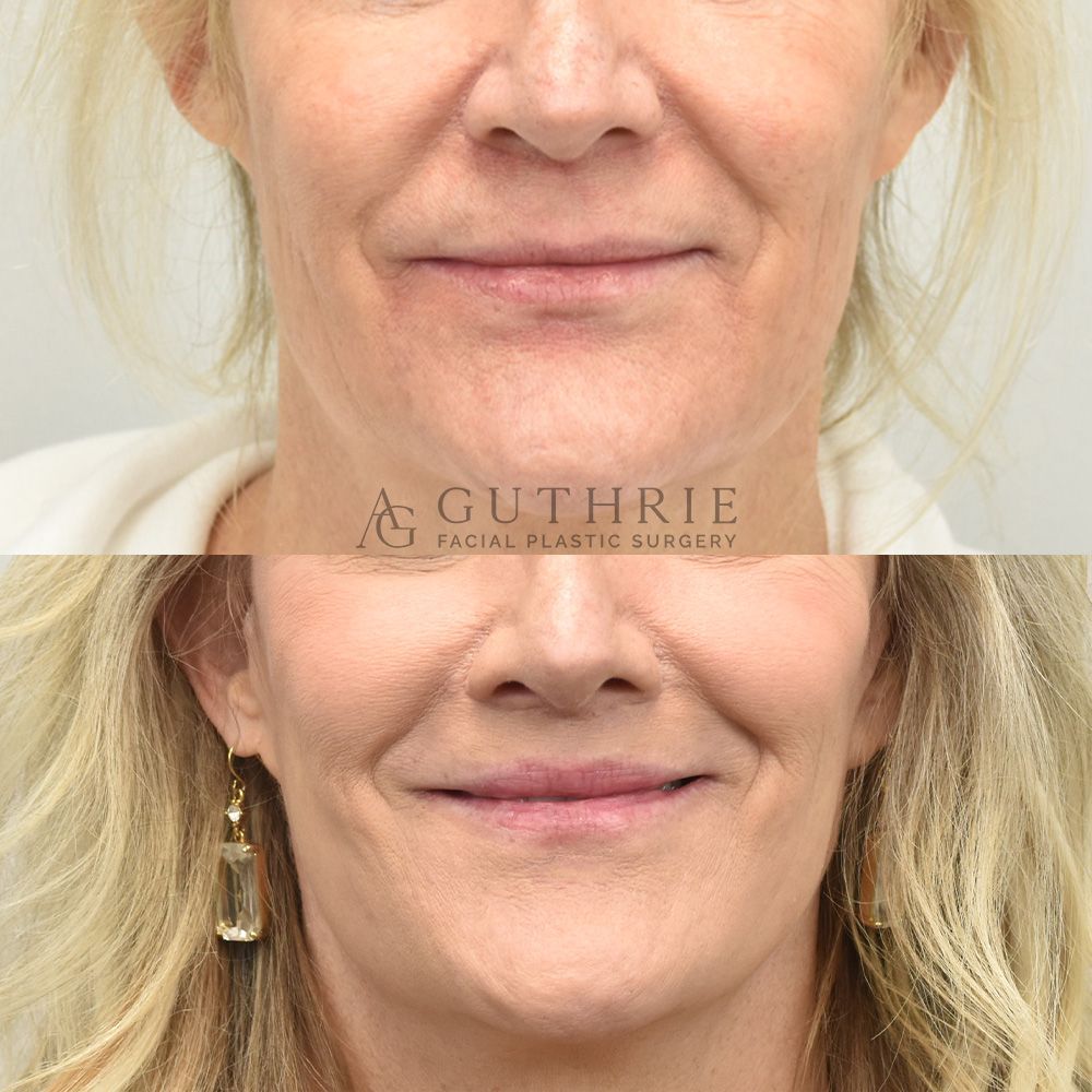 closeup of a woman's mouth before and after Lip Lift procedure