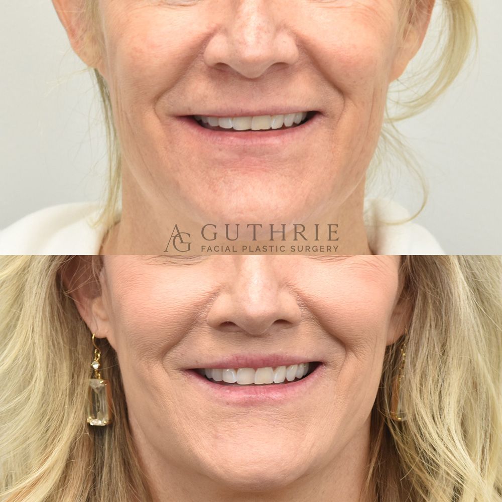 Before and After Subnasal Lip Lift