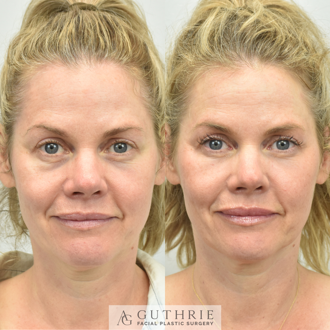 Before and After Fat Transfer to Cheeks and Undereyes