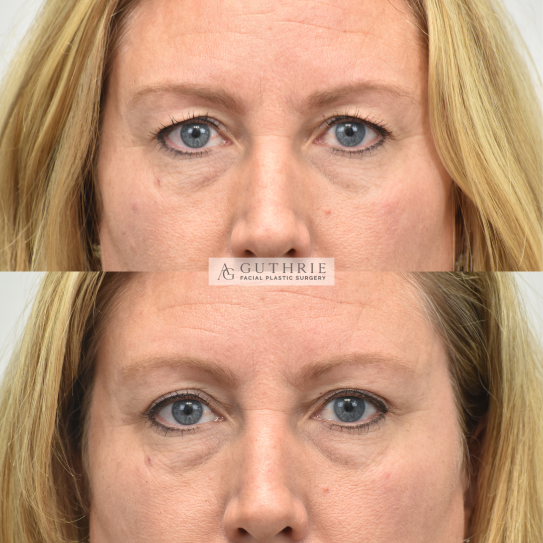 patient at guthrie facial plastic surgery in brentwood, tn - before and after upper blepharoplasty procedure